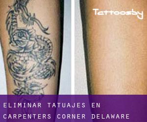 Eliminar tatuajes en Carpenters Corner (Delaware)