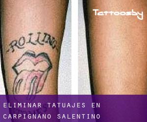 Eliminar tatuajes en Carpignano Salentino