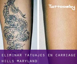Eliminar tatuajes en Carriage Hills (Maryland)