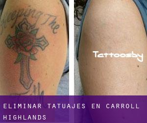 Eliminar tatuajes en Carroll Highlands