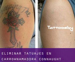 Eliminar tatuajes en Carrownamaddra (Connaught)