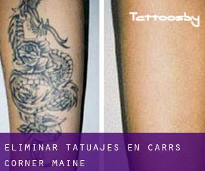 Eliminar tatuajes en Carrs Corner (Maine)