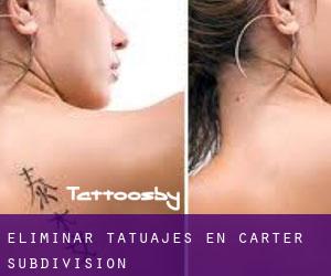 Eliminar tatuajes en Carter Subdivision