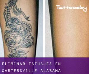 Eliminar tatuajes en Cartersville (Alabama)