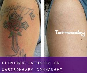 Eliminar tatuajes en Cartrongarv (Connaught)