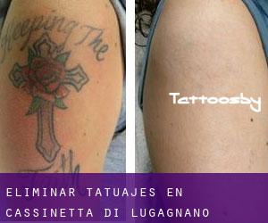 Eliminar tatuajes en Cassinetta di Lugagnano