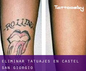 Eliminar tatuajes en Castel San Giorgio