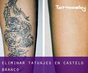 Eliminar tatuajes en Castelo Branco