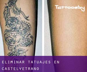 Eliminar tatuajes en Castelvetrano