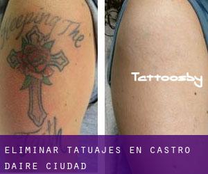 Eliminar tatuajes en Castro Daire (Ciudad)