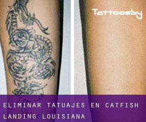 Eliminar tatuajes en Catfish Landing (Louisiana)
