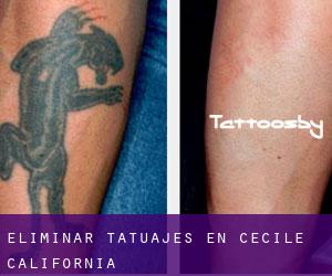 Eliminar tatuajes en Cecile (California)
