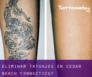 Eliminar tatuajes en Cedar Beach (Connecticut)