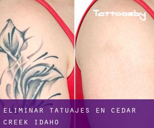 Eliminar tatuajes en Cedar Creek (Idaho)