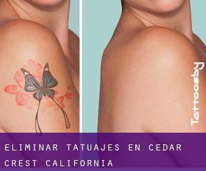 Eliminar tatuajes en Cedar Crest (California)