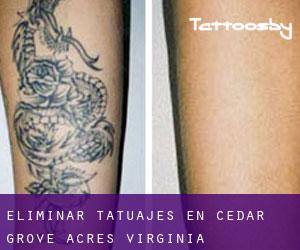 Eliminar tatuajes en Cedar Grove Acres (Virginia)