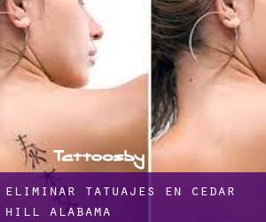 Eliminar tatuajes en Cedar Hill (Alabama)
