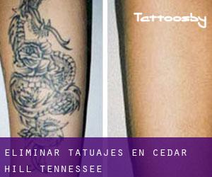 Eliminar tatuajes en Cedar Hill (Tennessee)