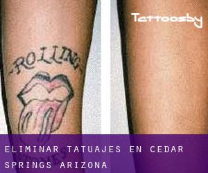 Eliminar tatuajes en Cedar Springs (Arizona)