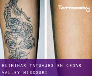Eliminar tatuajes en Cedar Valley (Missouri)