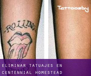 Eliminar tatuajes en Centennial Homestead