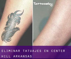Eliminar tatuajes en Center Hill (Arkansas)