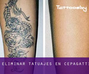 Eliminar tatuajes en Cepagatti