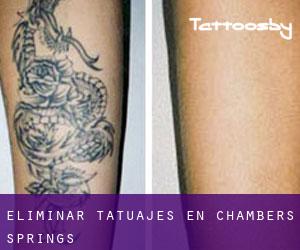 Eliminar tatuajes en Chambers Springs