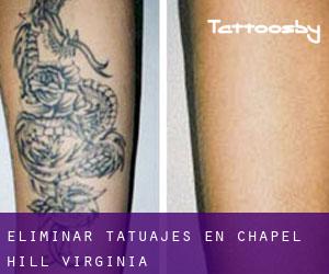 Eliminar tatuajes en Chapel Hill (Virginia)