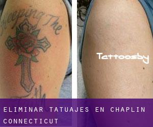 Eliminar tatuajes en Chaplin (Connecticut)
