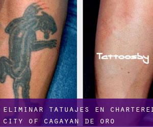 Eliminar tatuajes en Chartered City of Cagayan de Oro
