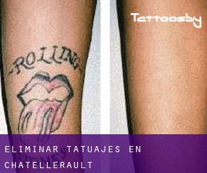 Eliminar tatuajes en Châtellerault