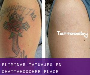 Eliminar tatuajes en Chattahoochee Place