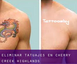 Eliminar tatuajes en Cherry Creek Highlands