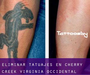 Eliminar tatuajes en Cherry Creek (Virginia Occidental)