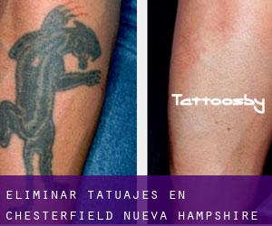 Eliminar tatuajes en Chesterfield (Nueva Hampshire)