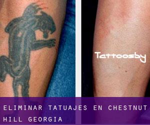 Eliminar tatuajes en Chestnut Hill (Georgia)