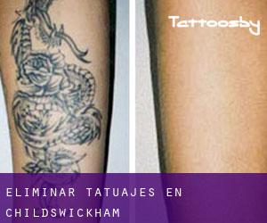 Eliminar tatuajes en Childswickham