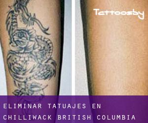 Eliminar tatuajes en Chilliwack (British Columbia)