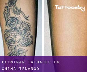 Eliminar tatuajes en Chimaltenango