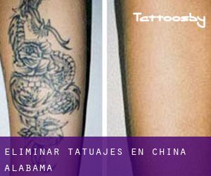 Eliminar tatuajes en China (Alabama)