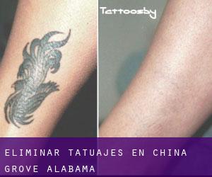 Eliminar tatuajes en China Grove (Alabama)