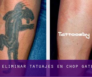 Eliminar tatuajes en Chop Gate