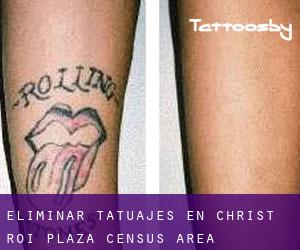 Eliminar tatuajes en Christ-Roi-Plaza (census area)