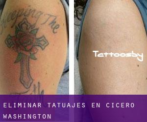 Eliminar tatuajes en Cicero (Washington)