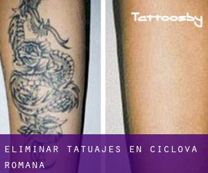 Eliminar tatuajes en Ciclova-Română