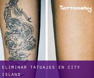Eliminar tatuajes en City Island