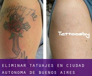 Eliminar tatuajes en Ciudad Autónoma de Buenos Aires