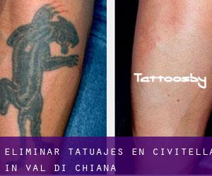 Eliminar tatuajes en Civitella in Val di Chiana