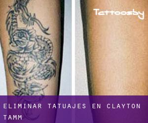 Eliminar tatuajes en Clayton-Tamm